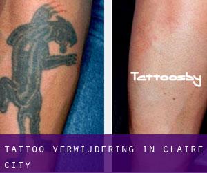 Tattoo verwijdering in Claire City