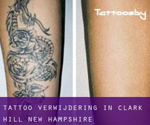Tattoo verwijdering in Clark Hill (New Hampshire)