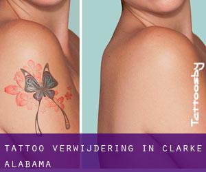 Tattoo verwijdering in Clarke (Alabama)