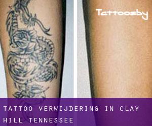 Tattoo verwijdering in Clay Hill (Tennessee)