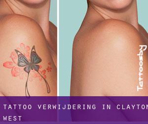 Tattoo verwijdering in Clayton West
