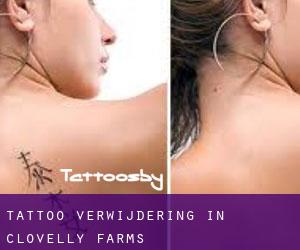Tattoo verwijdering in Clovelly Farms