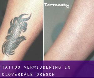 Tattoo verwijdering in Cloverdale (Oregon)