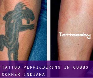 Tattoo verwijdering in Cobbs Corner (Indiana)