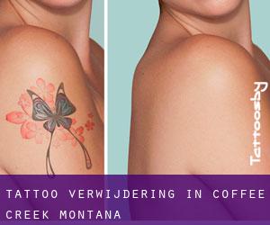 Tattoo verwijdering in Coffee Creek (Montana)
