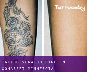 Tattoo verwijdering in Cohasset (Minnesota)