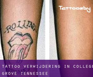 Tattoo verwijdering in College Grove (Tennessee)