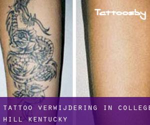 Tattoo verwijdering in College Hill (Kentucky)