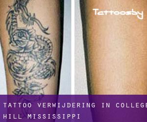 Tattoo verwijdering in College Hill (Mississippi)