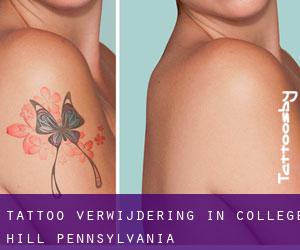 Tattoo verwijdering in College Hill (Pennsylvania)
