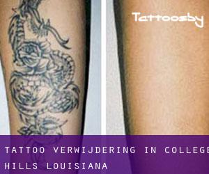 Tattoo verwijdering in College Hills (Louisiana)