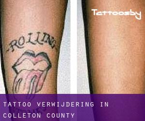 Tattoo verwijdering in Colleton County