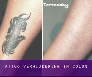 Tattoo verwijdering in Colón