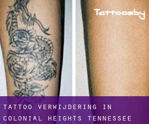 Tattoo verwijdering in Colonial Heights (Tennessee)