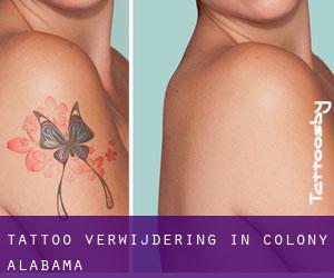 Tattoo verwijdering in Colony (Alabama)