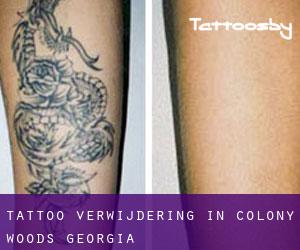 Tattoo verwijdering in Colony Woods (Georgia)