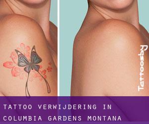 Tattoo verwijdering in Columbia Gardens (Montana)