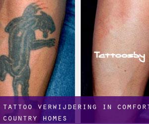 Tattoo verwijdering in Comfort Country Homes