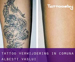 Tattoo verwijdering in Comuna Albeşti (Vaslui)