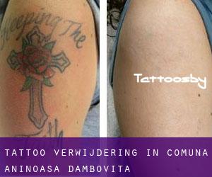 Tattoo verwijdering in Comuna Aninoasa (Dâmboviţa)