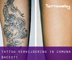Tattoo verwijdering in Comuna Băceşti