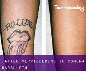 Tattoo verwijdering in Comuna Bărbuleţu