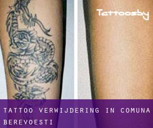 Tattoo verwijdering in Comuna Berevoeşti