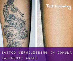 Tattoo verwijdering in Comuna Călineşti (Argeş)