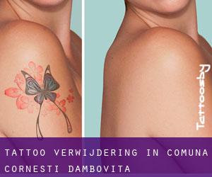 Tattoo verwijdering in Comuna Corneşti (Dâmboviţa)