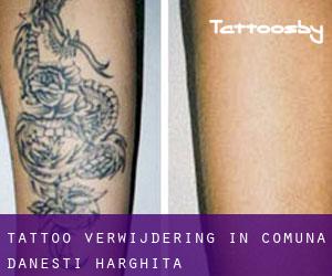 Tattoo verwijdering in Comuna Dăneşti (Harghita)
