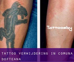 Tattoo verwijdering in Comuna Dofteana