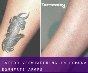 Tattoo verwijdering in Comuna Domneşti (Argeş)