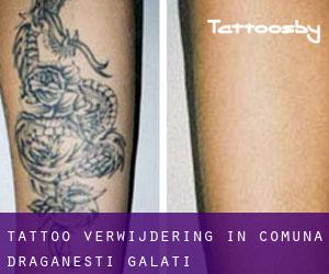Tattoo verwijdering in Comuna Drăgăneşti (Galaţi)