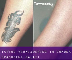 Tattoo verwijdering in Comuna Drăguşeni (Galaţi)