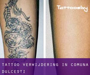 Tattoo verwijdering in Comuna Dulceşti