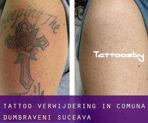 Tattoo verwijdering in Comuna Dumbrăveni (Suceava)