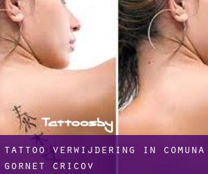 Tattoo verwijdering in Comuna Gornet-Cricov