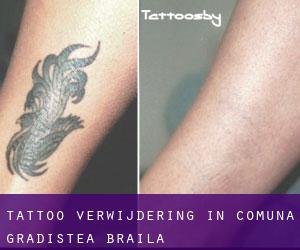 Tattoo verwijdering in Comuna Grădiştea (Brăila)