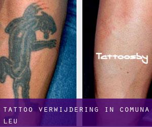 Tattoo verwijdering in Comuna Leu