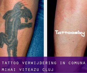 Tattoo verwijdering in Comuna Mihai Viteazu (Cluj)