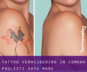 Tattoo verwijdering in Comuna Pãuleşti (Satu Mare)