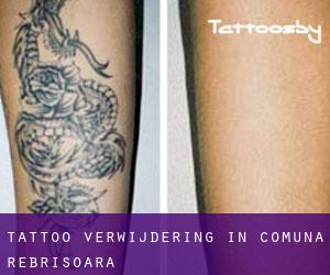 Tattoo verwijdering in Comuna Rebrişoara
