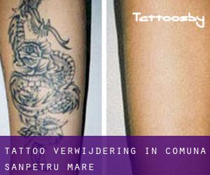 Tattoo verwijdering in Comuna Sânpetru Mare