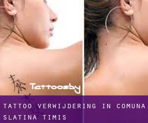 Tattoo verwijdering in Comuna Slatina-Timiş