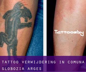Tattoo verwijdering in Comuna Slobozia (Argeş)