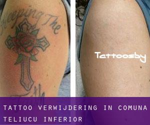 Tattoo verwijdering in Comuna Teliucu Inferior