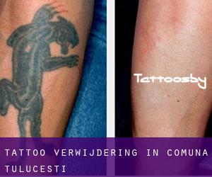 Tattoo verwijdering in Comuna Tuluceşti