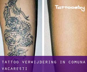 Tattoo verwijdering in Comuna Văcăreşti