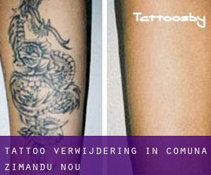 Tattoo verwijdering in Comuna Zimandu Nou