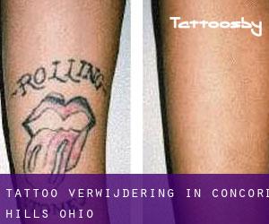 Tattoo verwijdering in Concord Hills (Ohio)